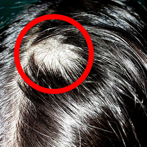 Alopecia areata: parches mensajeros del cuerpo.