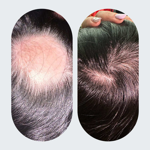 Efluvio telógeno vs alopecia androgénica: ¿cuál es tu caso?