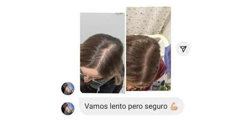 RECUPERACIÓN REAL Caso de alopecia androgénica femenina - Tiempos y rutinas ILEV Routine