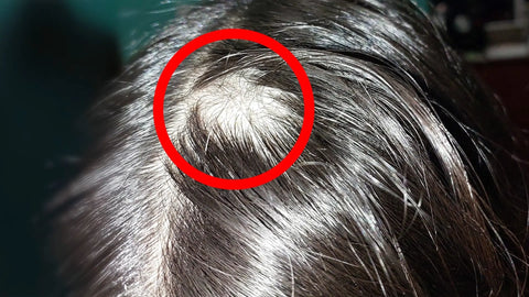 Alopecia areata: parches mensajeros del cuerpo. ILEV Routine